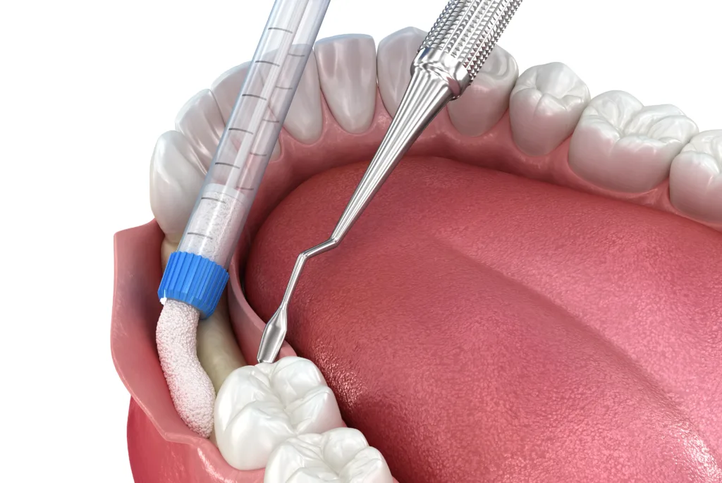 dental bone grafting round rock tx