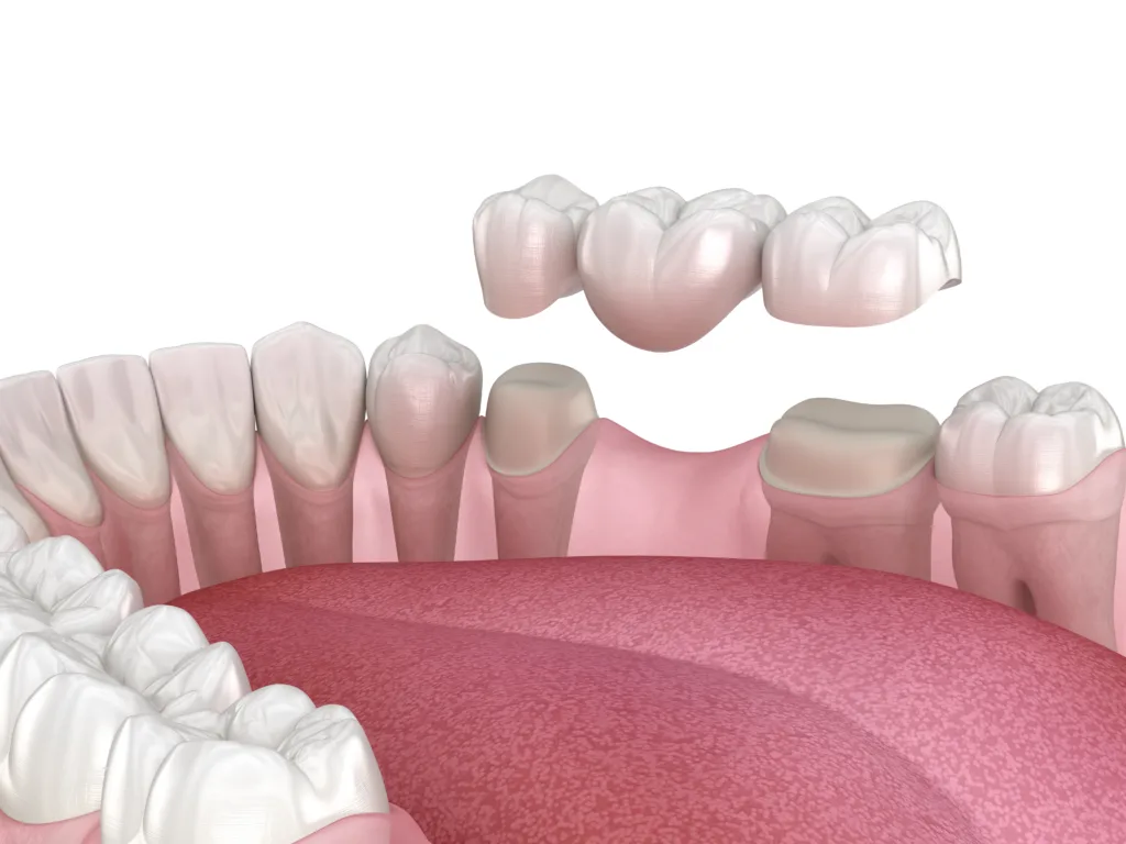 3D illustration of a dental bridge above the gap it will fill