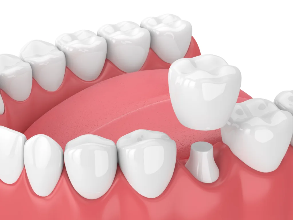 3D illustration of a dental crown being placed over a prepared tooth
