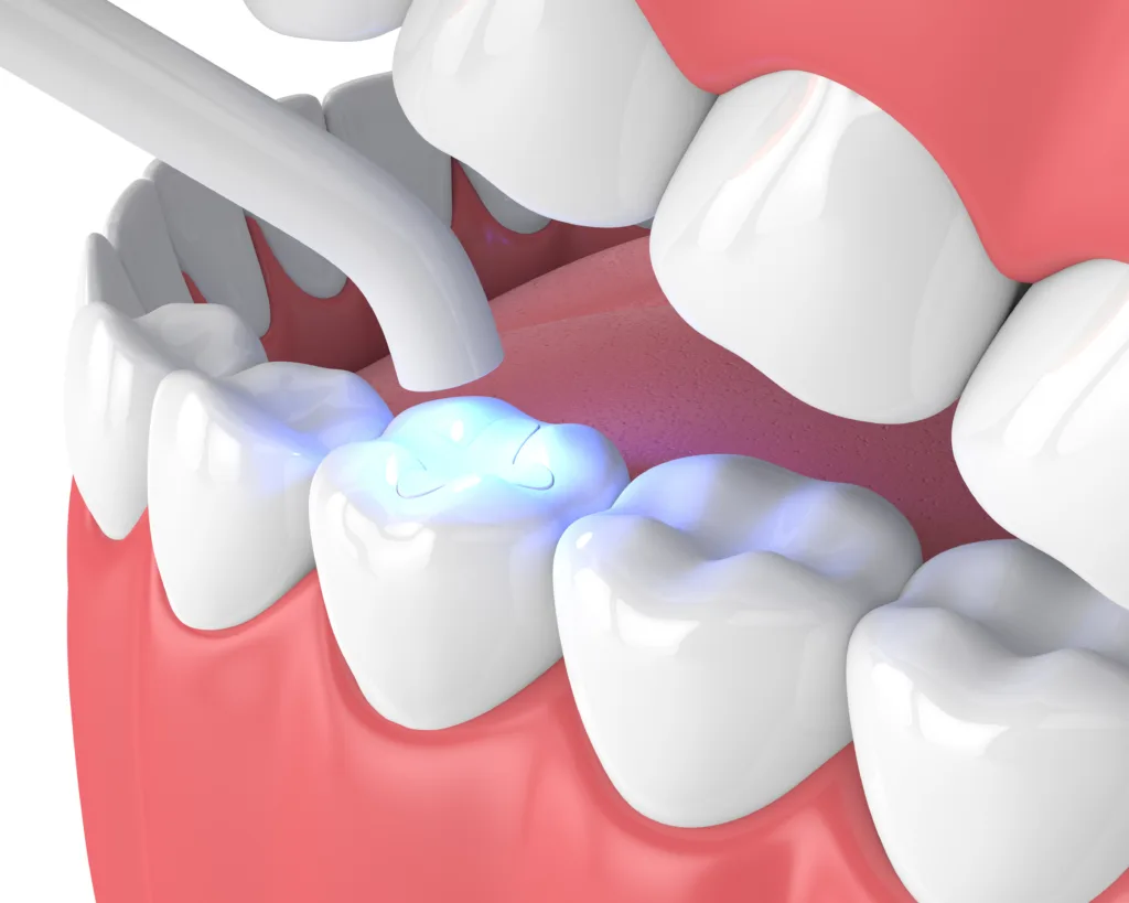 dental fillings round rock tx
