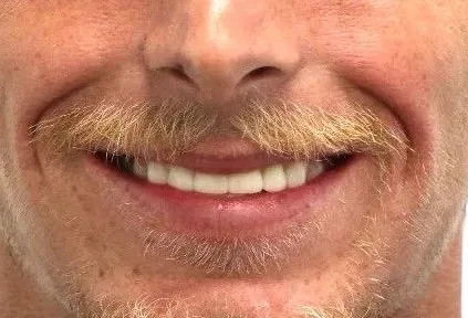 dental implants near me round rock tx