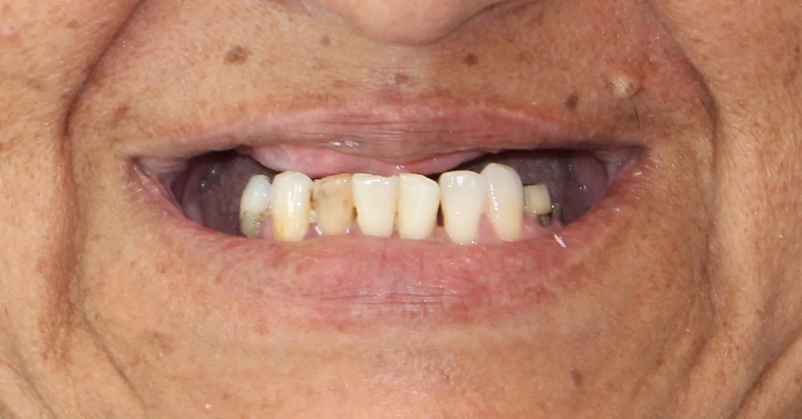 dental implants austin texas