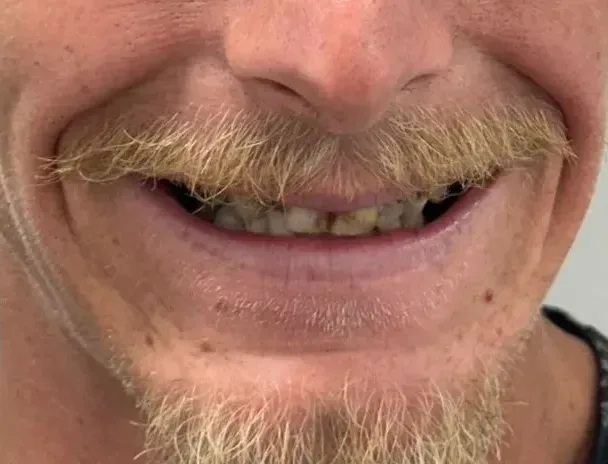 dental implants near me round rock tx