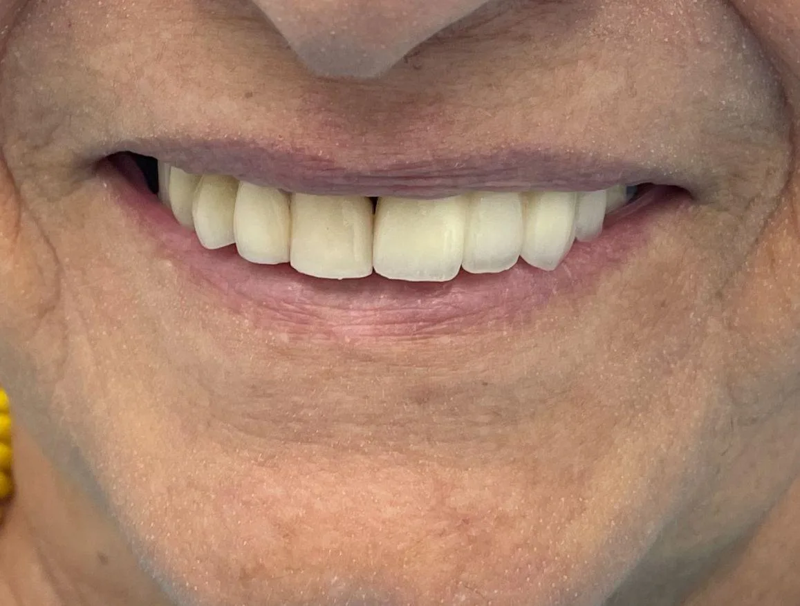 dental implants near me round rock tx