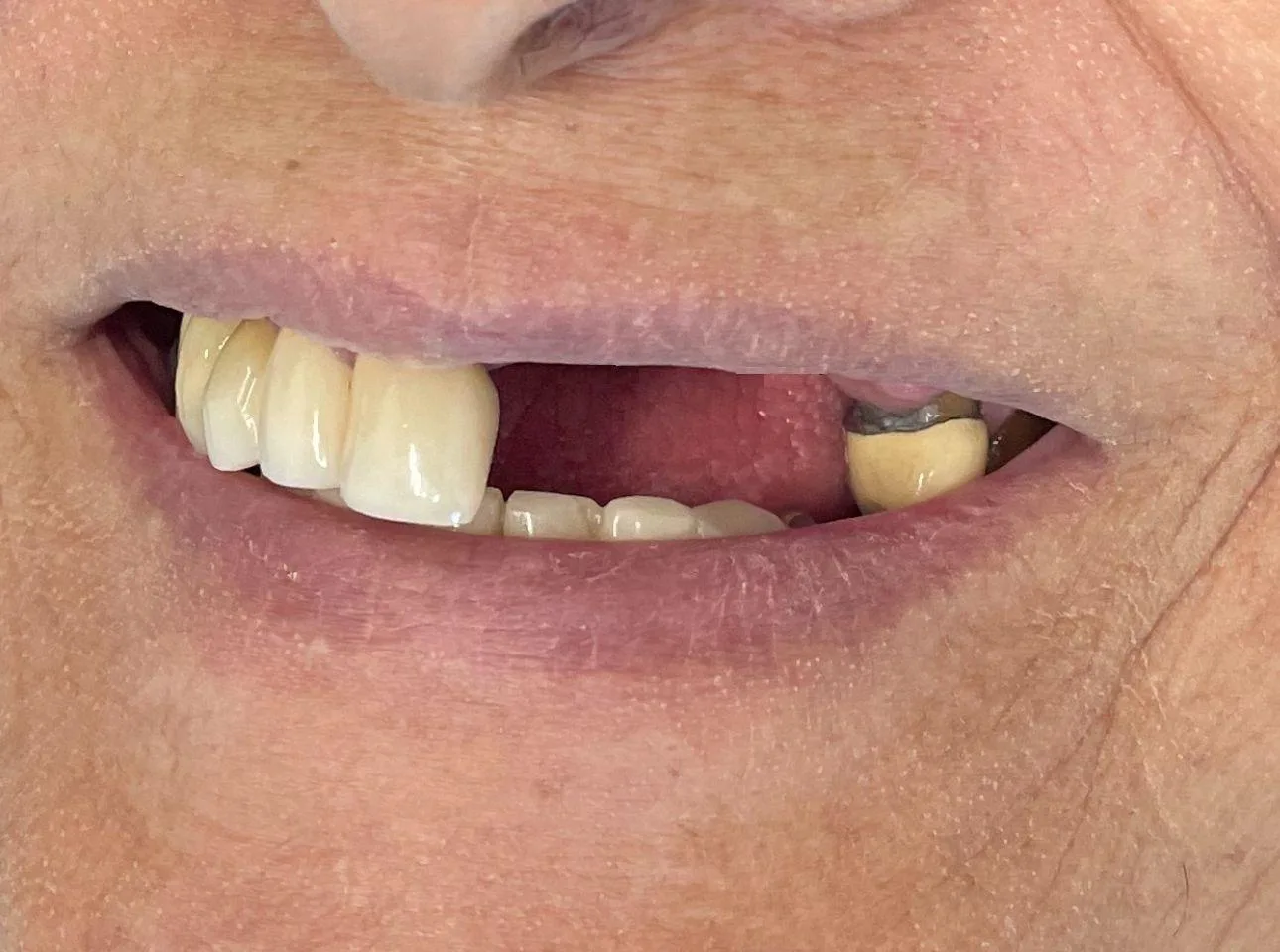 dental implants near me round rock tx