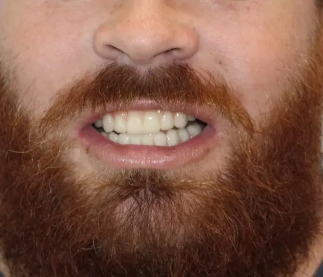 dental implants near me round rock tx