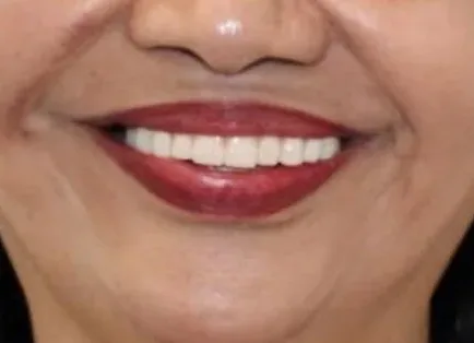 dental implants near me round rock tx