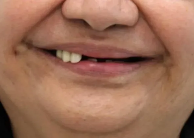 dental implants near me round rock tx