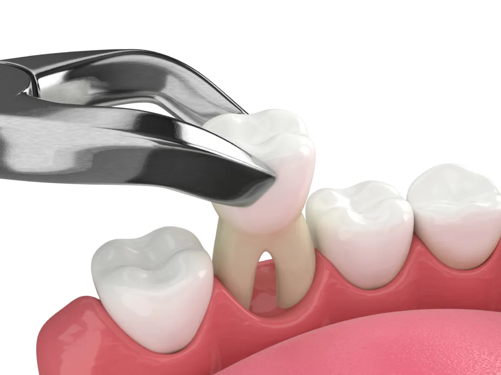 tooth extraction round rock texas