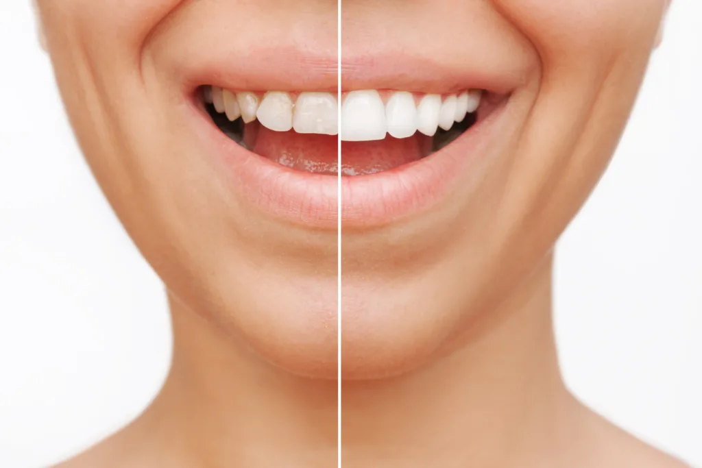 veneers round rock texas