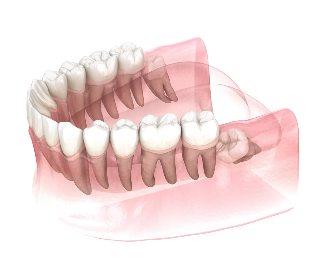 wisdom teeth removal round rock texas