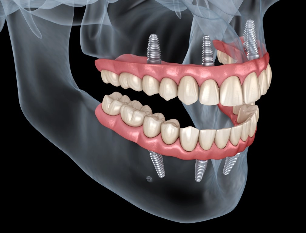 Sinus Augmentation: An Innovative Solution for Bone Loss Sinus Augmentation: An Innovative Solution for Bone Loss