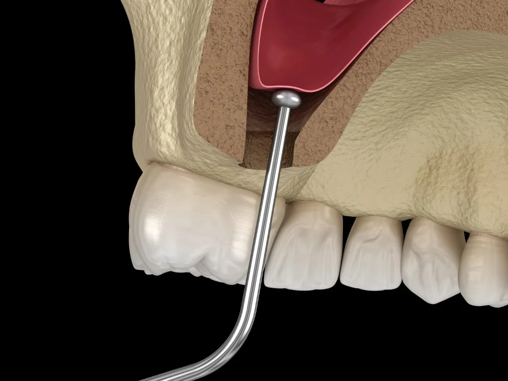 Sinus Augmentation: An Innovative Solution for Bone Loss Sinus Augmentation: An Innovative Solution for Bone Loss