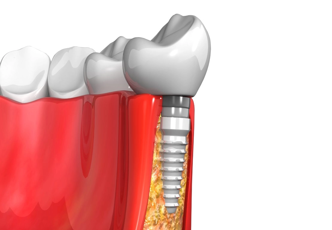 Understanding Dental Implant Failure: Causes, Signs, and Prevention Understanding Dental Implant Failure: Causes, Signs, and Prevention