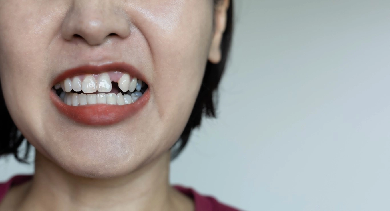 What to Do if Your Tooth Gets Knocked Out What to Do if Your Tooth Gets Knocked Out